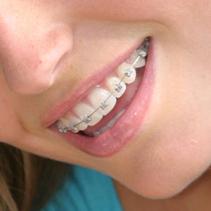 Damon Selbstligierende Brackets · Ohne Zähne ziehen · Fachzahnärzte für Kieferorthopädie · Dr. Fricke & Dr. Ritschel