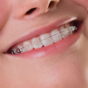 Damon-Clear Keramikbrackets · Ohne Zähne ziehen · Fachzahnärzte für Kieferorthopädie · Dr. Fricke & Dr. Ritschel